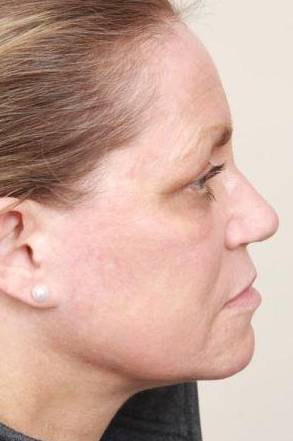 after laser skin resurfacing right side view female patient case 2874
