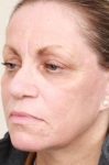 after laser skin resurfacing left angle view female patient case 2874
