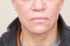 after laser skin resurfacing lower face view female patient case 2874