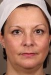 before laser skin resurfacing front view female patient case 2883