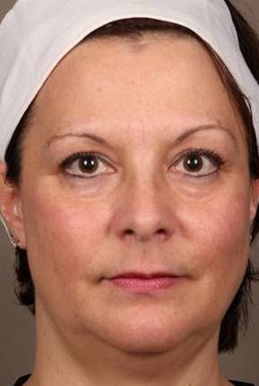 before laser skin resurfacing front view female patient case 2883