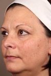 before laser skin resurfacing left angle view female patient case 2883