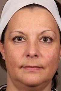 after laser skin resurfacing front view female patient case 2883