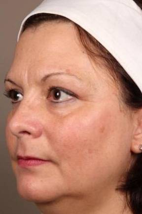 after laser skin resurfacing left angle view female patient case 2883