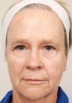 before laser skin resurfacing front view female patient case 2888