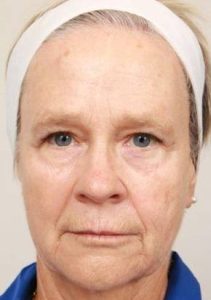 before laser skin resurfacing front view female patient case 2888