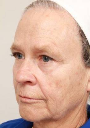before laser skin resurfacing left angle view female patient case 2888