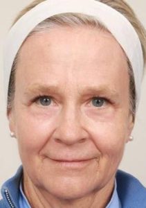 after laser skin resurfacing front view female patient case 2888