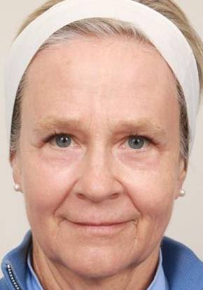 after laser skin resurfacing front view female patient case 2888