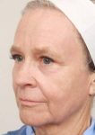 after laser skin resurfacing left angle view female patient case 2888