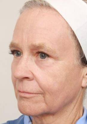 after laser skin resurfacing left angle view female patient case 2888