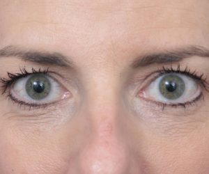 before laser skin resurfacing front view female patient case 2893