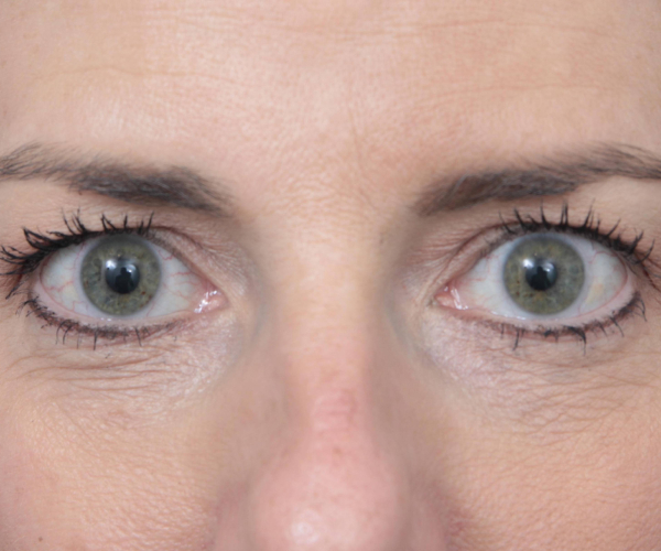 before laser skin resurfacing front view female patient case 2893