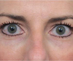 after laser skin resurfacing front view female patient case 2893