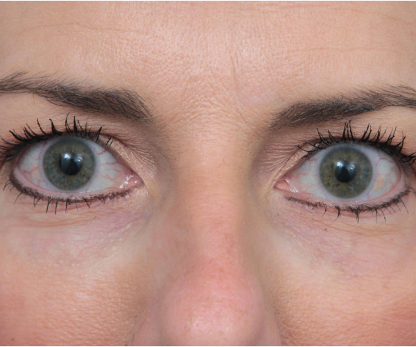after laser skin resurfacing front view female patient case 2893