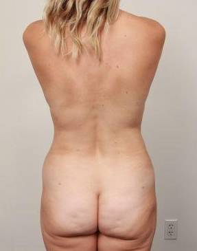after liposuction female patient back view case 3535