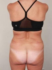 after liposuction female patient back view case 3541