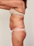 before liposuction female patient left side view case 3541