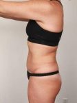 after liposuction female patient left side view case 3541