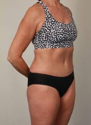 after liposuction female patient right angled view case 3541
