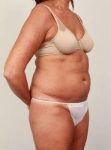 before liposuction female patient right angled view case 3541
