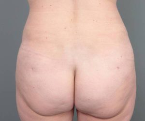 after liposuction female patient back view case 3548