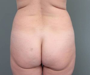 before liposuction female patient back view case 3548