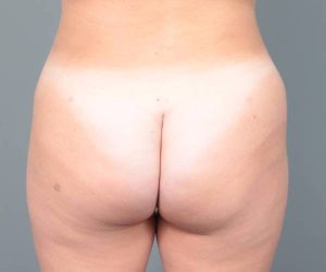 after liposuction female patient back view case 3551