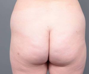 before liposuction female patient back view case 3551