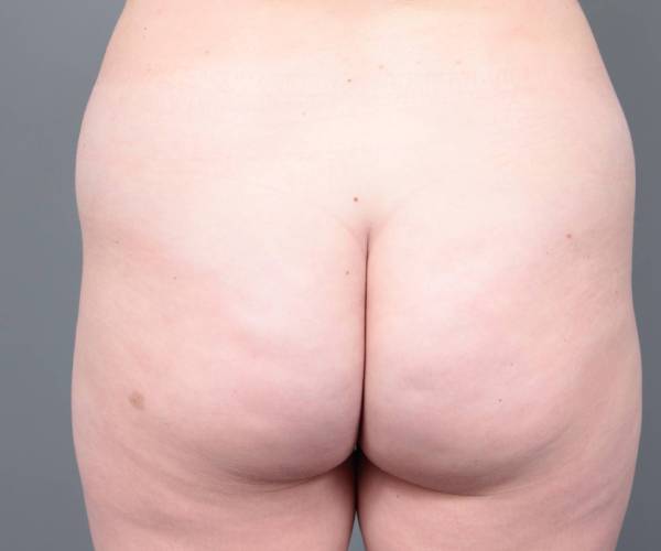 before liposuction female patient back view case 3551