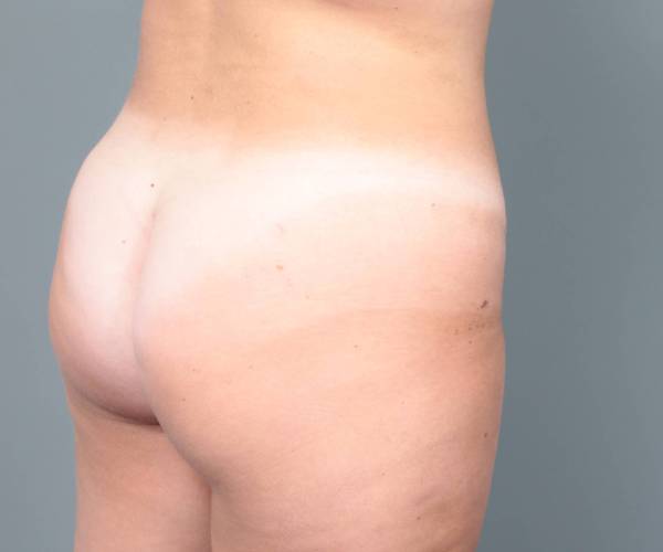 after liposuction female patient right backside view case 3551