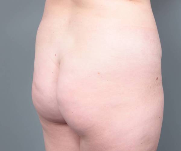 before liposuction female patient right backside view case 3551