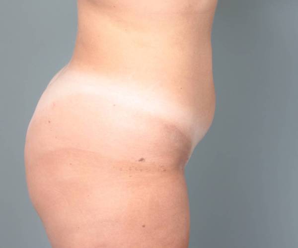 after liposuction female patient right side view case 3551