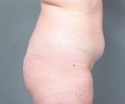 before liposuction female patient right side view case 3551