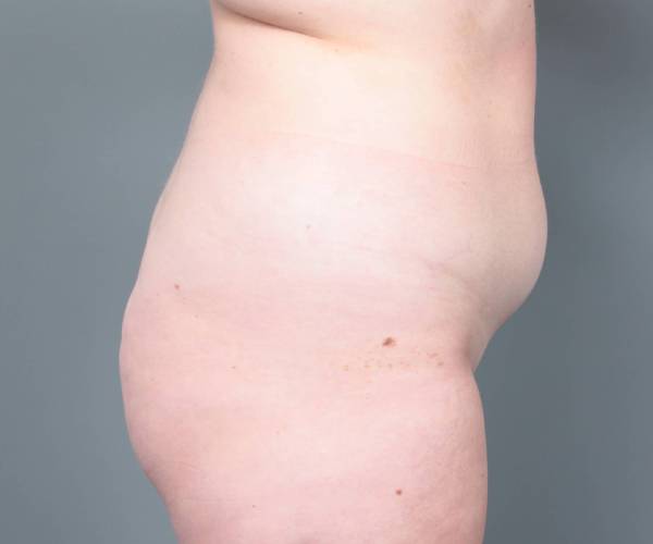 before liposuction female patient right side view case 3551