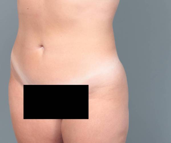 after liposuction female patient left angled view case 3551