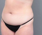 before liposuction female patient left angled view case 3551