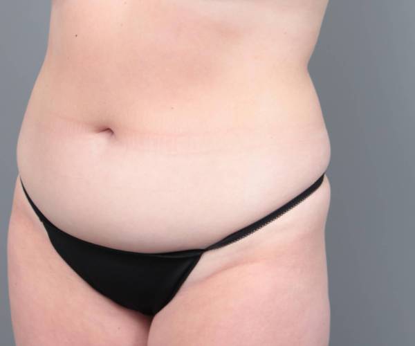 before liposuction female patient left angled view case 3551
