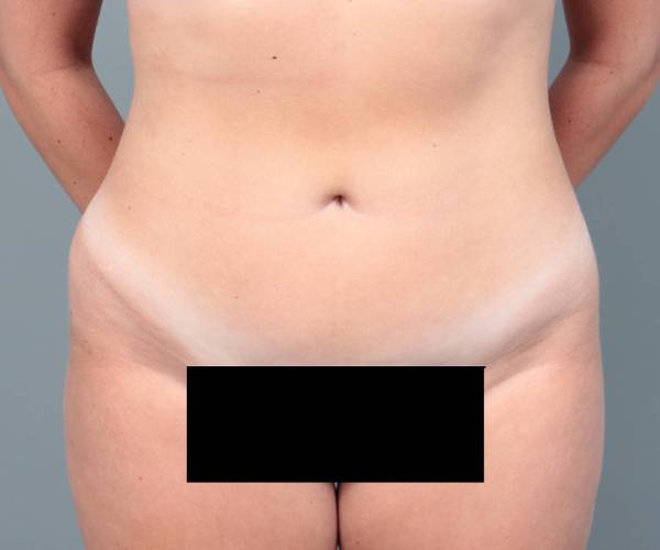 after liposuction female patient front view case 3551