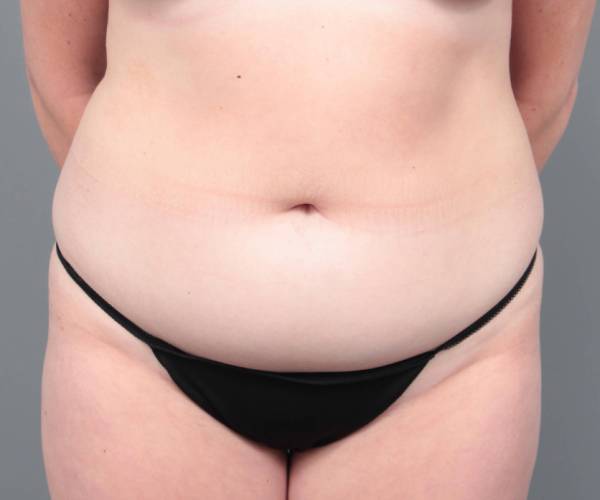 before liposuction female patient front view case 3551