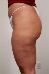 After CELLULAZE Female Patient Left Side Angle View Case 3806