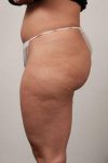 Before CELLULAZE Female Patient Left Side Angle View Case 3806