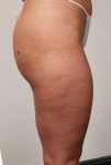 After CELLULAZE Female Patient Right Side Angle View Case 3806