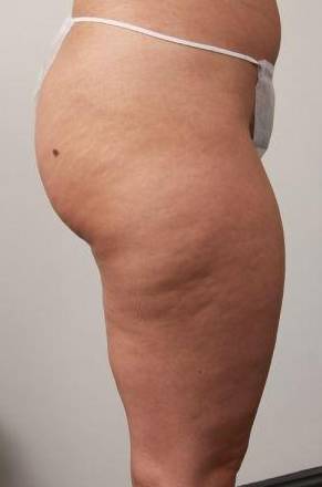 Before CELLULAZE Female Patient Right Side Angle View Case 3806