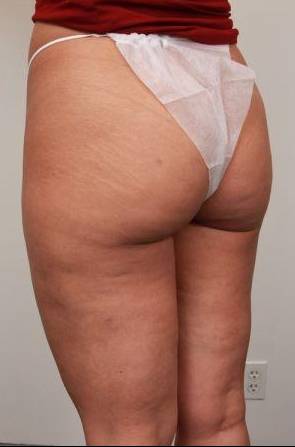 After CELLULAZE Female Patient Diagonal Angle View Case 3806