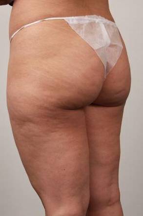 Before CELLULAZE Female Patient Diagonal Angle View Case 3806