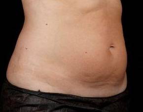 After SculpSure® Female Patient Diagonal Angle View Case 3826