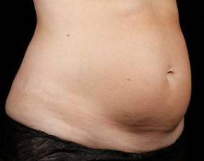 Before SculpSure® Female Patient Diagonal Angle View Case 3826