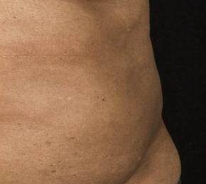 After SculpSure® Female Patient Zoomed View Case 3829