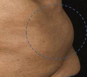Before SculpSure® Female Patient Zoomed View Case 3829